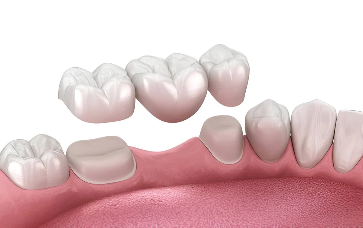 dental bridges near you